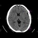 Early changes of brain ischemia, MCA: CT - Computed tomography